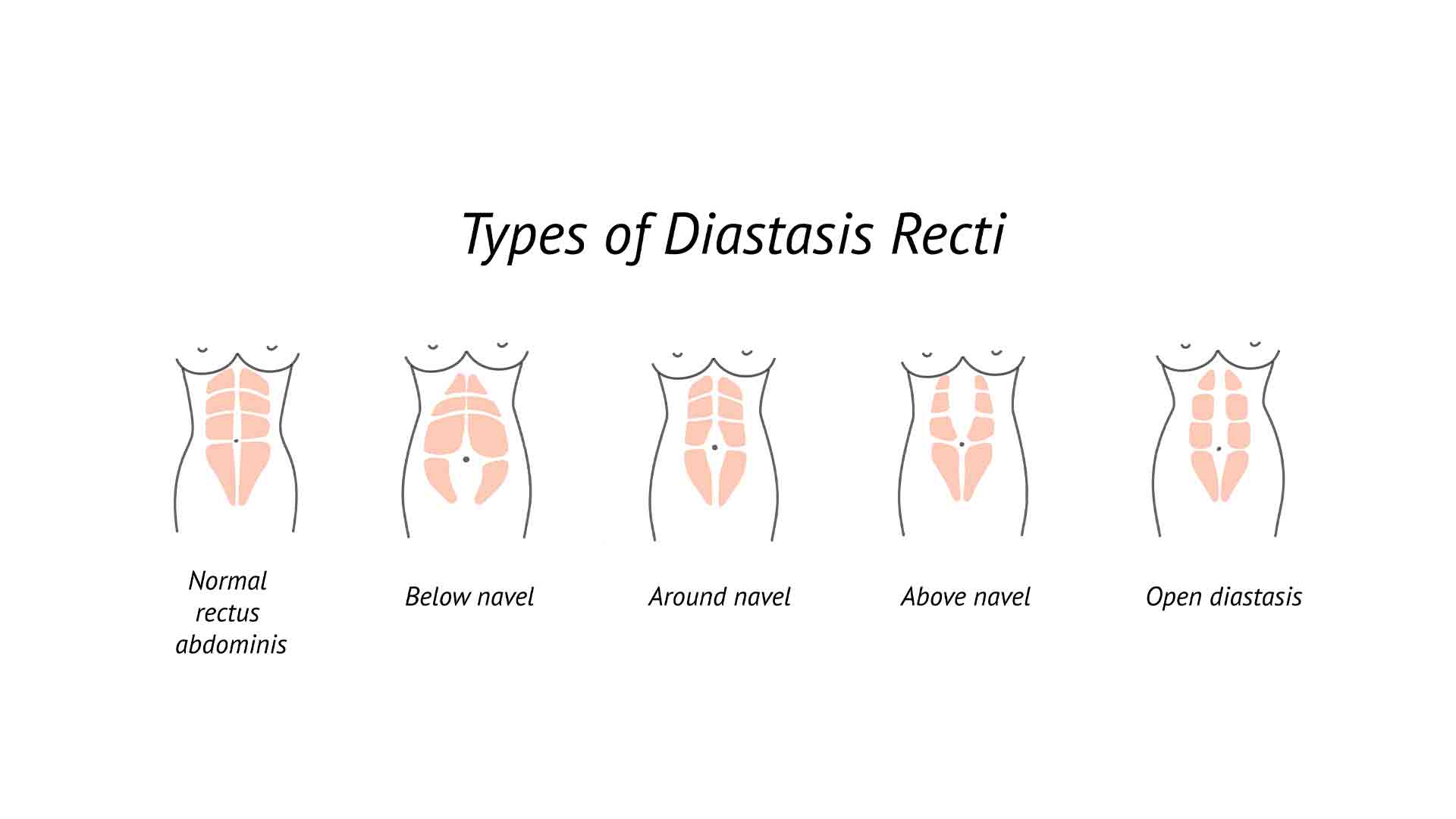 Different abdominal muscles in women